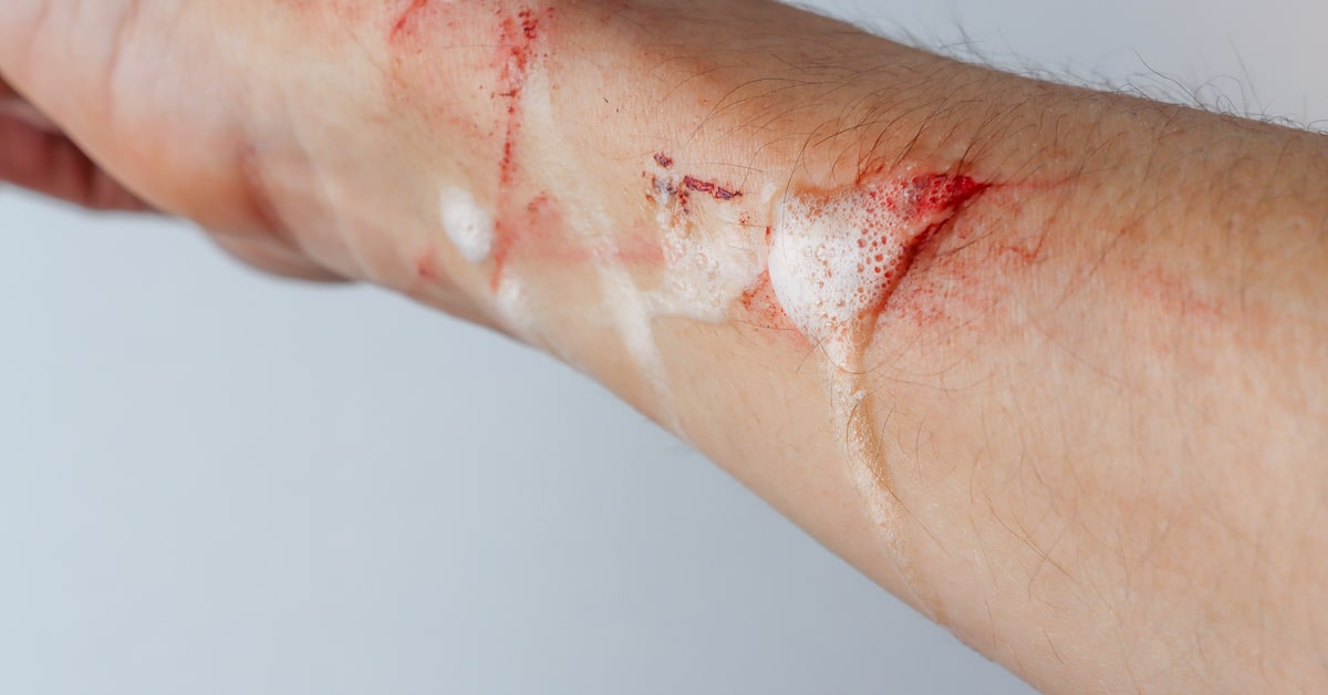 injured-hand-with-wound-from-which-blood-flows-after-treatment-with-disinfectant-solution