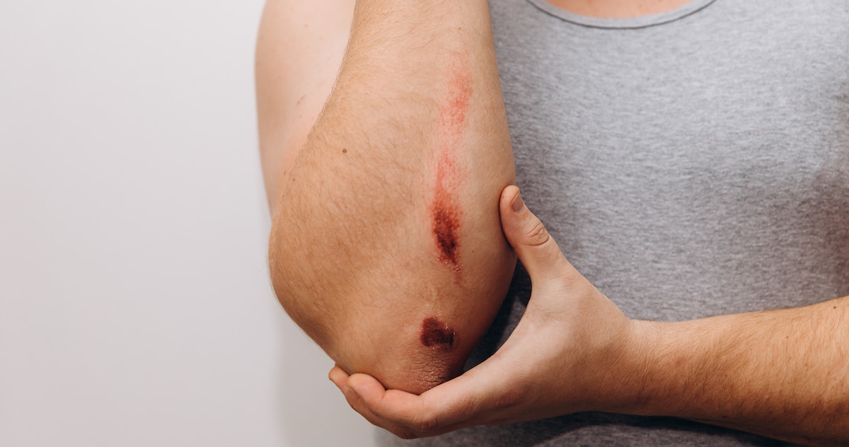 large-abrasions-forearm-man-after-fall-man-holds-his-elbow-with-his-hand